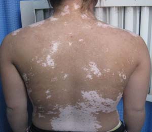 常见的治疗白癜风的方法有哪些