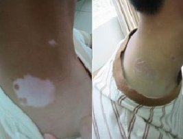 颈部白癜风治疗佳治疗时机