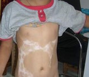 胸部白癜风怎么治疗快能好