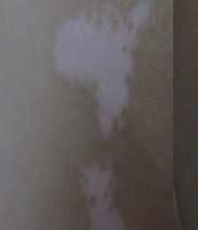 紫外线照射过度会对白癜风患者产生哪些影响