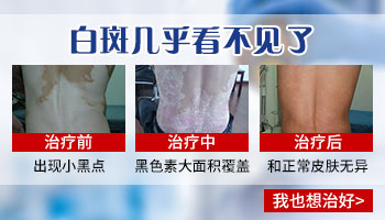 脚趾上的白癜风怎么治疗