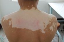 背部白癜风常见的症状是什么