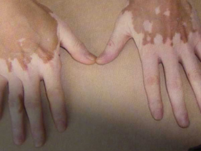 手部出现白斑好的治疗方法是什么