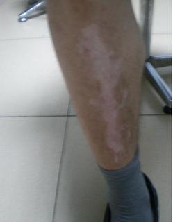 腿上出现白斑如何诊断是不是白癜风