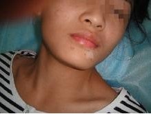 诱发青少年白癜风病发的原因有哪些