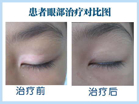 眼部白癜风佳治疗方法是什么