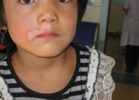 儿童脸上长白斑是白癜风症状吗