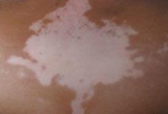 男性为什么会得白癜风