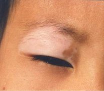 小孩子得了白癜风怎么治疗