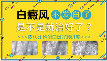 石家庄哪家白癜风医院的308是真的