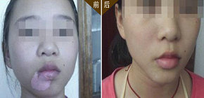 如何能快速有效的治疗白癜风