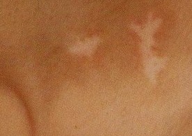 遗传性白癜风治疗起来难吗