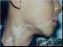 颈部白癜风扩散该怎么办