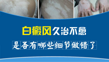 白癜风患者可以用白醋洗脸吗