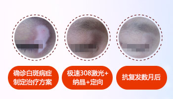 一周的宝宝微量元素缺失会得白癜风吗