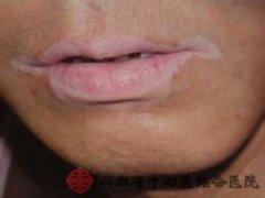 嘴唇部白癜风有治好的么?