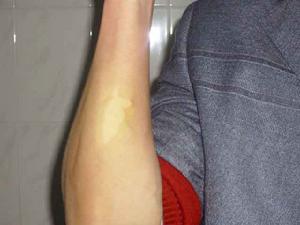 胳膊长白斑怎么回事