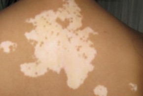 白癜风痊愈大约花费多少钱