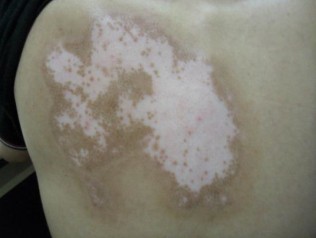 节段型白癜风好治吗