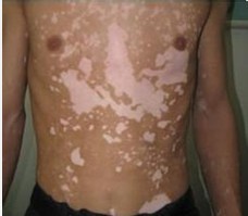 白癜风什么时候扩散的快