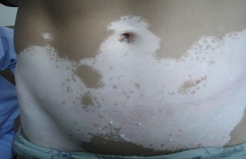 腿上肚皮白班是怎么回事