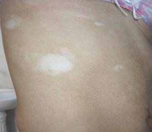 白癜风早期颜色就很白吗