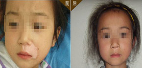 儿童脸上身上有白癜风