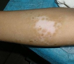 手臂上的白斑是不是白癜风