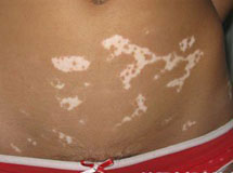 白癜风什么情况下能做黑色素移植