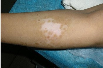 皮肤上出现白斑是缺维生素吗