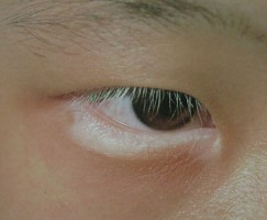 黑光治疗白癜风对眼睛有影响吗