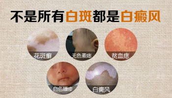 石家庄白癜风哪家医院好