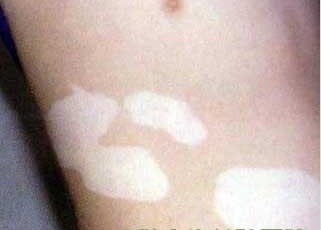 腰部一块白的是白癜风吗