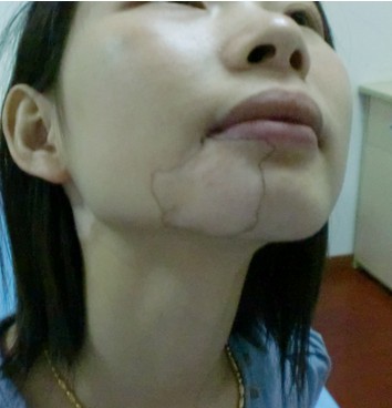 嘴唇上的白癜风能吗