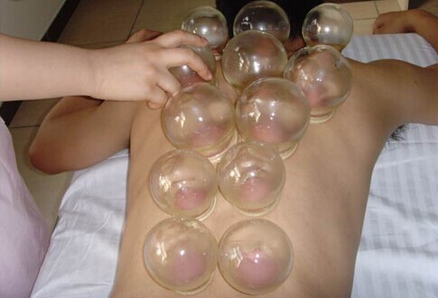 拔罐能治白癜风吗