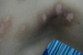 308激光出现水疱怎么办