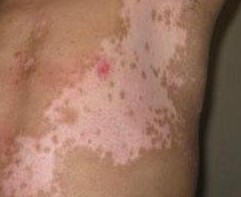 白癜风表皮移植多长时间能好