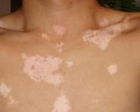 人体皮肤表面有白色小斑点是什么