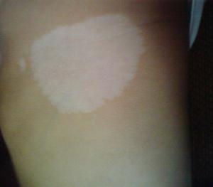 无花果治疗白癜风