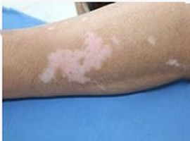 白癜风照UVB好还是308好