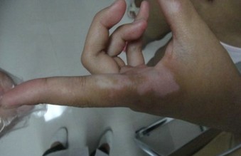 烧伤致色素脱失也是白癜风吗