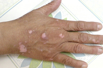 手背长好多不规则白块