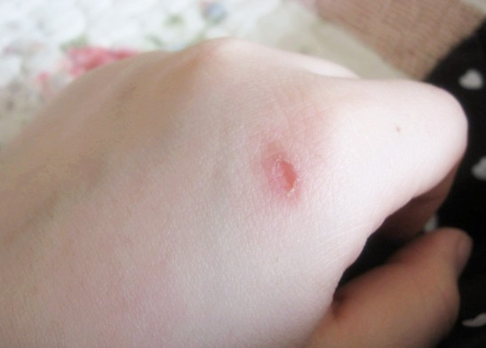 动物咬伤也会导致白癜风吗