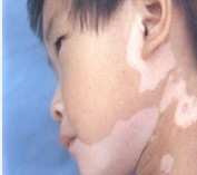 孩子4岁面部有淡白斑是什么原因
