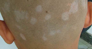 308能彻底白癜风吗