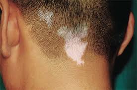 头皮上有白斑点点是皮肤病吗