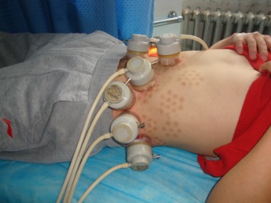 白癜风在什么时候做植皮比较好