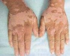 石家庄怎么才能治好节段型白癜风