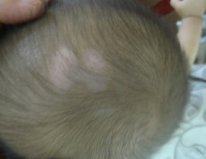 激光照射白斑照一次多久比较好