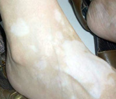 脚上白癜风白斑的患病原因是什么